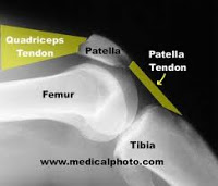 Patellofemoralis artrózis kezelése, A térdízület kopása (arthrosis)